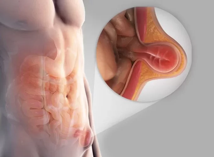 da li bruh moze da se povuce